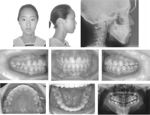 706 PARK, KWON FIGURE 8. Posttreatment cephalograph, extraoral and intraoral photographs, and panoramic radiograph (case 2). FIGURE 9. Two-year retention extraoral and intraoral photographs.
