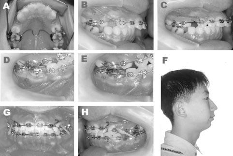 intruding force application (D, E), extraoral photographs at 11 months of treatment (F), and intraoral photographs at 18 months of treatment (G, H). curve of Spee (three mm).