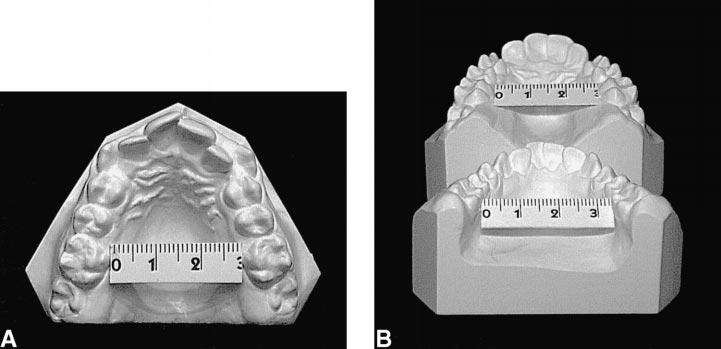 RAPID PALATAL EXPANSION AND CERVICAL TRACTION 91 FIGURE 5. Pretreatment model casts at 12 years of age.