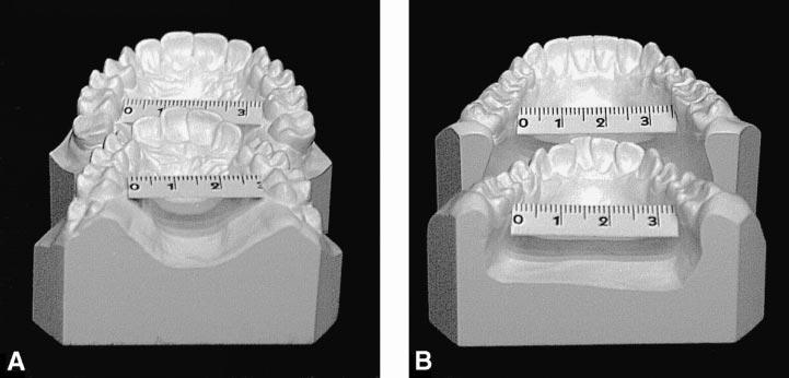92 LIMA, LIMA FIGURE 7. Model casts. (A) Posterior maxillary occlusal view at 12 and 30 years of age. (B) Posterior mandibular occlusal view at 12 and 30 years of age.