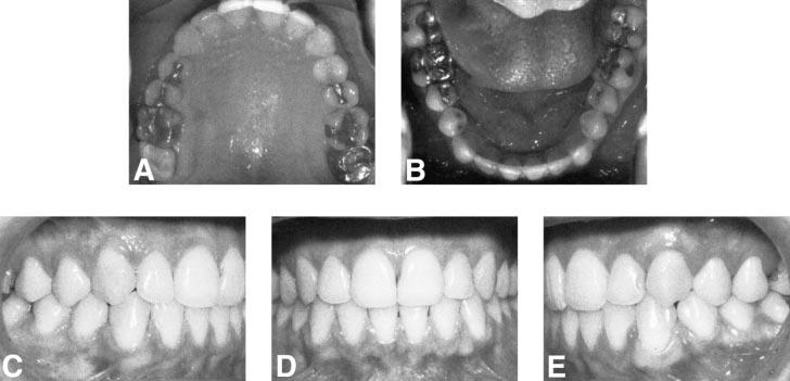 RAPID PALATAL EXPANSION AND CERVICAL TRACTION 93 FIGURE 9. Long-term posttreatment intraoral photographs at age 30. TABLE 2.