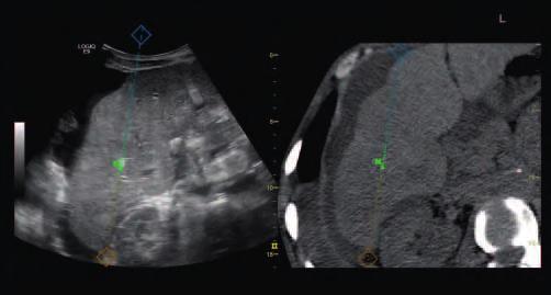 Hyperplasia with 9L-D probe Volume Navigation: a complete suite of features including tracking GPS markers, Fusion imaging capabilities (now also with