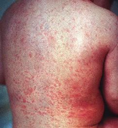 Rubella Vaccine: MMR Rubella (German measles) is an airborne virus that causes swollen glands, a slight fever, rash, and occasionally arthritis-like symptoms.