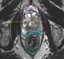 In-Room MRI Guidance Current In-Room CBCT Future