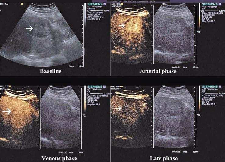 Focal liver lesions evaluated by contrast enhanced ultrasound 59 2.