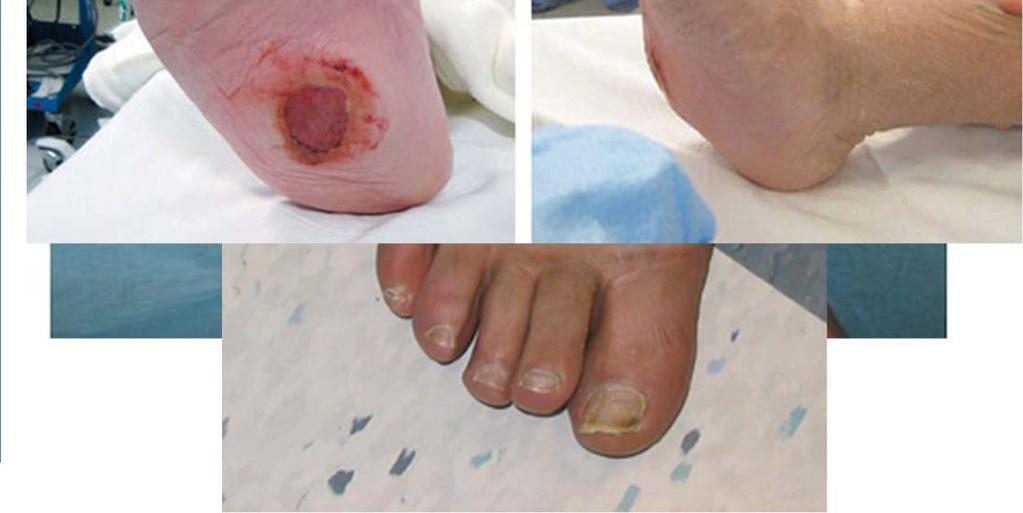 Medial arch collapse Ankle/Hindfoot deformity Callous