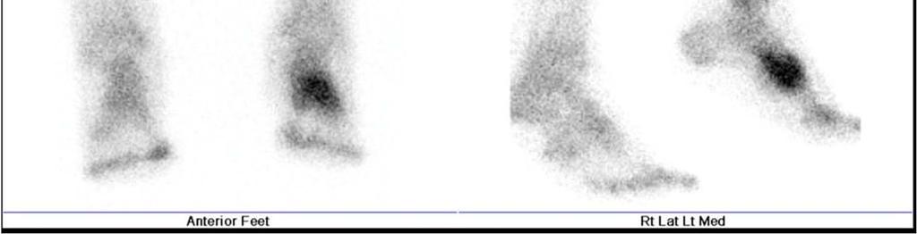 scan: Negative (cold) in Charcot Positive