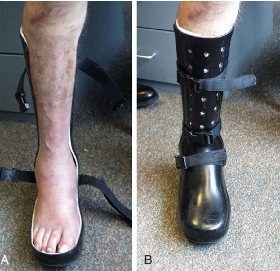 Non-Operative Treatment Step 2: CROW (Charcot restraint orthotic walker) boot Custom removable brace