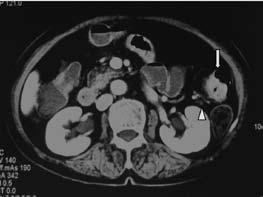 Barium enema revealed an irregular elevated lesion at the splenic flexure. Passage of barium was nearly obstructed by the severe stenosis. No abnormal findings were seen in other sites of the colon.