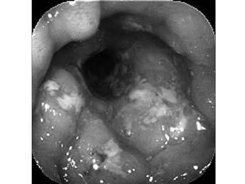 Figure 4: Histological examination shows a wide range of ulcers and crypt abscesses (arrow) (a, 20; b, 100) 25 Figure 5: Barium enema 9 months after surgery shows lead