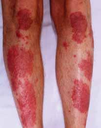 Clinical practice 33 Figure 2. Psoriasis, lower limbs corticosteroids are the mainstay of management.