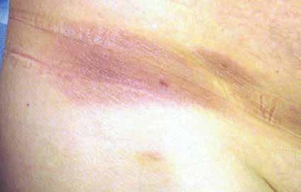 Mycosis fungoides Mycosis fungoides is the commonest form of Cutaneous T-cell Lymphoma (CTCL), with a median age of onset of 55 years.