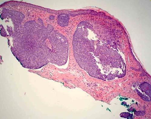 60 yo man with lid lesion basal cell carcinoma Malignant neoplasm of the skin. The nests and strands exhibit peripheral palisading.