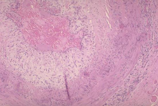 70 yo man with vision loss. giant cell arteritis Granulomatous inflammation of small to medium sized arteries.