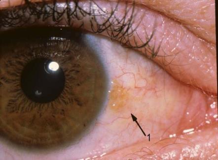 Clinical-Pathological Correlation of Common Periocular Lesions Todd Mondzelewski, MD Comprehensive Ophthalmology and Ophthalmic Pathology Naval Medical