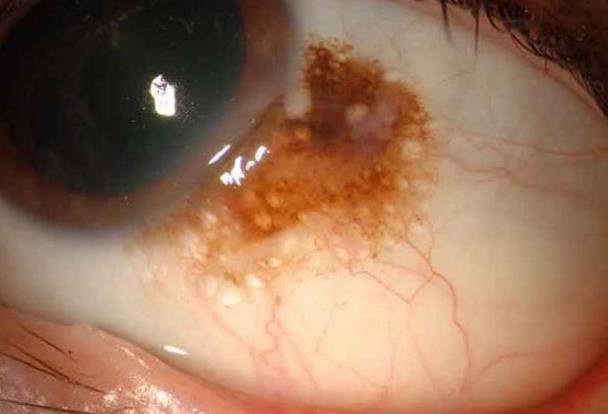 bandshaped keratopathy, climatic droplet keratopathy, proteinaceous corneal degeneration, elastotic degeneration, Fisherman s keratopathy, and Eskimo s