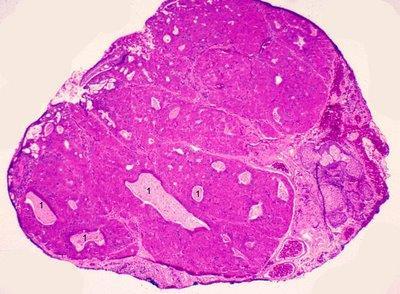 As seen in the photograph the epithelium is thickened and spongiotic