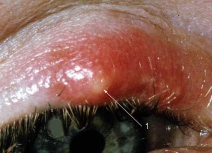 The hallmark of fungal keratitis is the necrotizing keratitis that in general is