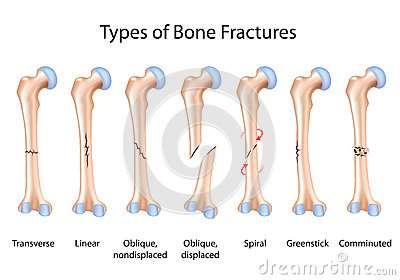 Q.6. Ans. Greenstick fracture : An incomplete fracture in which a bone bends and cracks. This type of fracture usually occurs in children because their bone are soft and flexible.