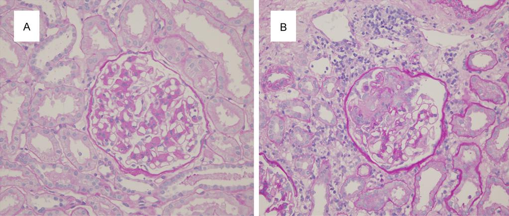 Figure 2. With increasing HBV-DNA replication, the main damage for IgA nephropathy was aggravation of the tubulointerstitial damage (A, B).