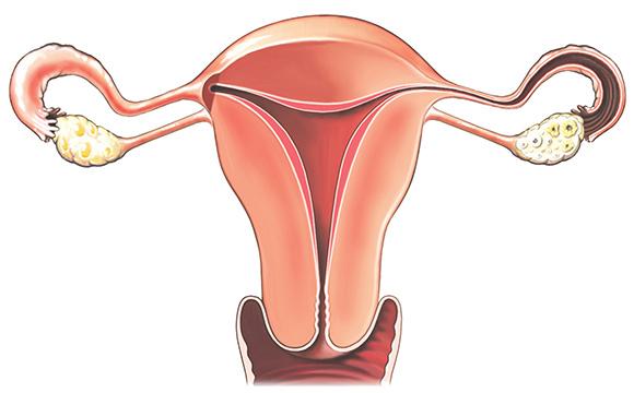 What is a vaginal hysterectomy? A vaginal hysterectomy is an operation to remove your uterus (womb) and cervix (neck of your womb) through your vagina.