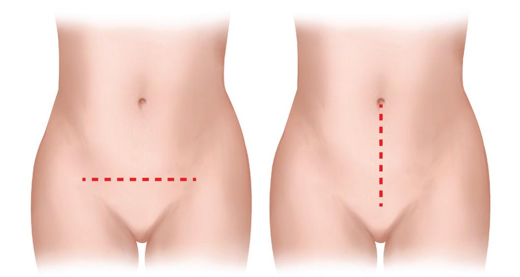 This chart provides an overview of the different ways your surgery may be performed.