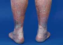 Figure 1: Normal skin versus psoriasis Healthy skin epidermis = healthy epidermal cell maturation time white blood cells