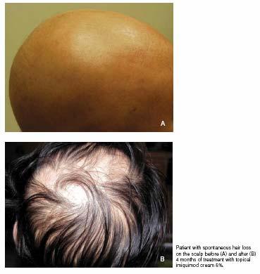 5% imiquimod in alopecia universalis, applied