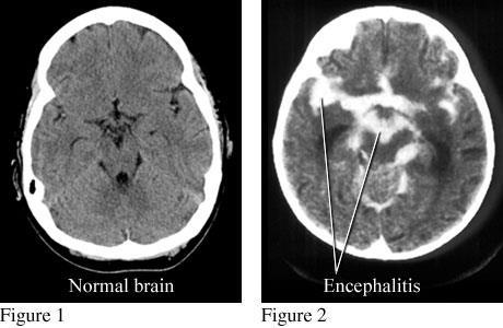 Encephalitis Inflammation of the brain Cause- usually viral (chemical) Symptoms- severe headache, fever, lethargy, extreme