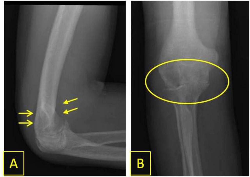 Fig. 9: Lateral (A) and oblique (B) elbow radiographs demonstrates displacement of the fat pads (closed and open arrows), as well as