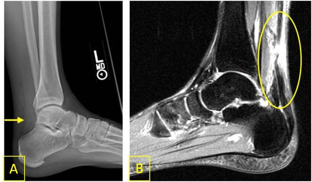 Fig. 4: Normal: Lateral ankle radiograph. Kager's fat pad is outlined. Fig.