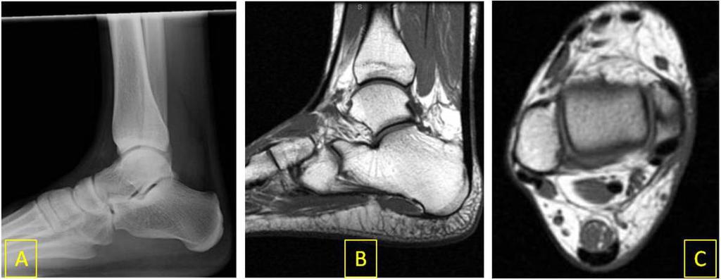 suggesting Achilles tendon rupture. MRI (B) confirms complete Achilles tendon rupture. Fig.