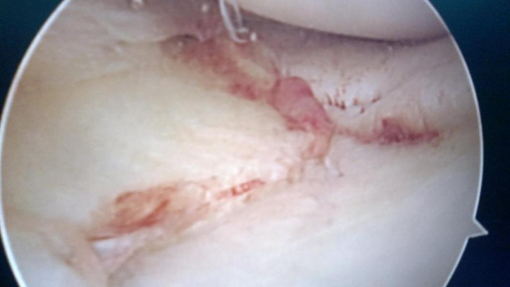 Arthroscopic pictures of tibial plateau fractures with meniscal injuries DISCUSSION There is much controversy regarding the management of meniscal injuries associated with tibial plateau fractures.
