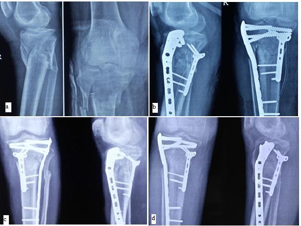 infection 2. stiffness (<90 knee flexion). 3. posttraumatic arthritis 4. non-union. 5. hardware impingement 6. implant failure.