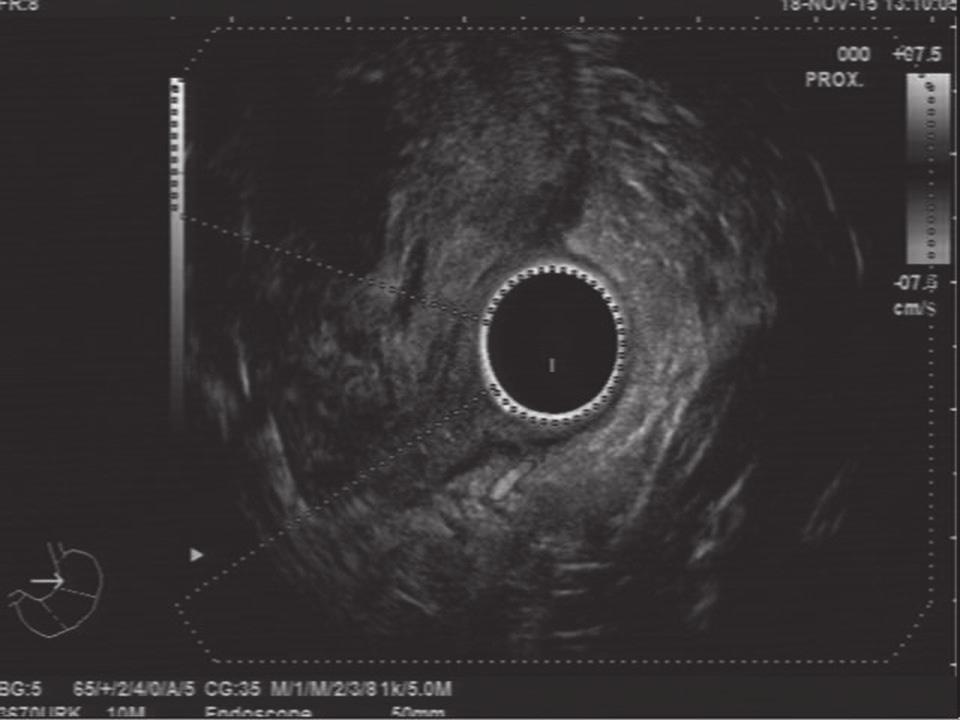 Figure 3: Endoscopic ultrasonography revealed avascular a heteroechoic submucosal mass at the posterolateral wall of the duodenum.