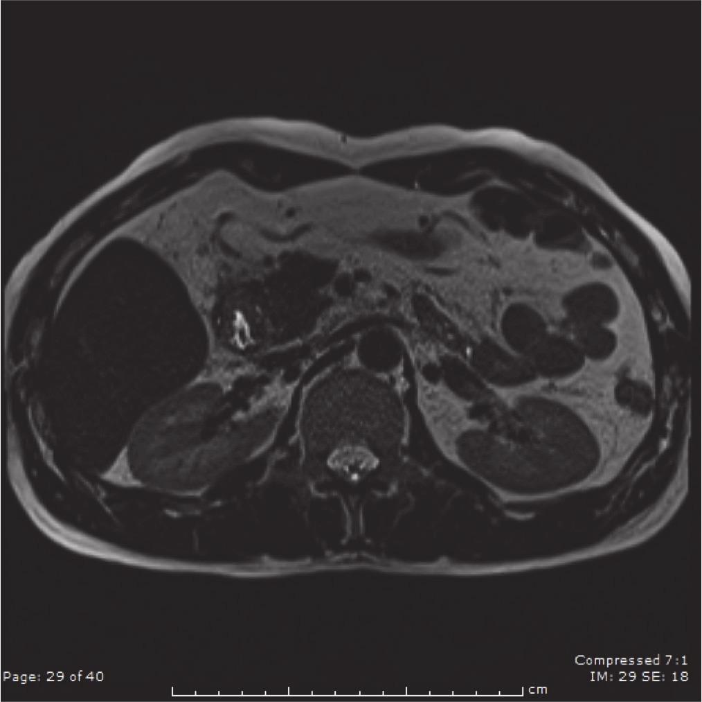In this case, the patient presented with abdominal pain, hematemesis, and jaundice. The only positive findings upon physical examination were jaundice and mild tenderness over the epigastric region.