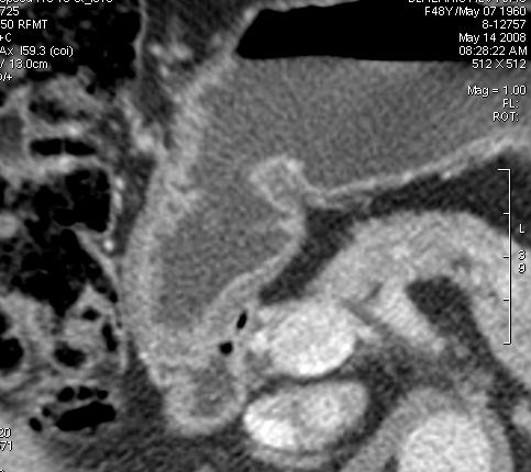 Stomach CT Normal gastric wall cearly visible as two or three layers; - mucosa (intensively enhancing layer) -