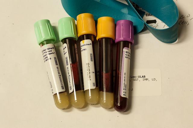 Bloods FBC, U&E, LFT, CRP TFT, B12, Folate if