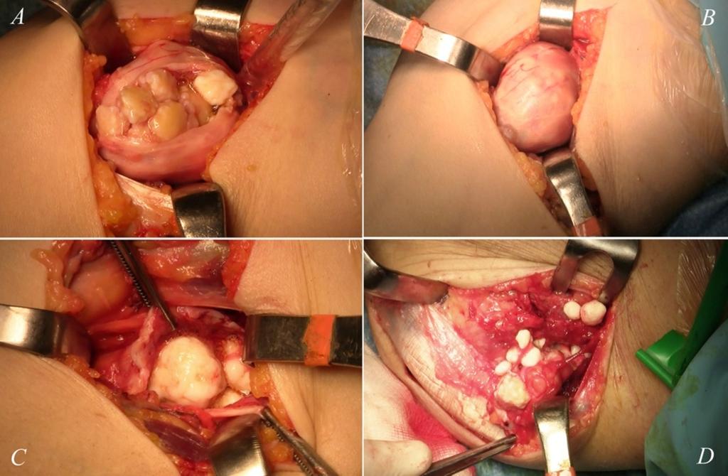 WORLD JOURNAL OF SURGICAL ONCOLOGY Neglected synovial osteochondromatosis of the elbow: a