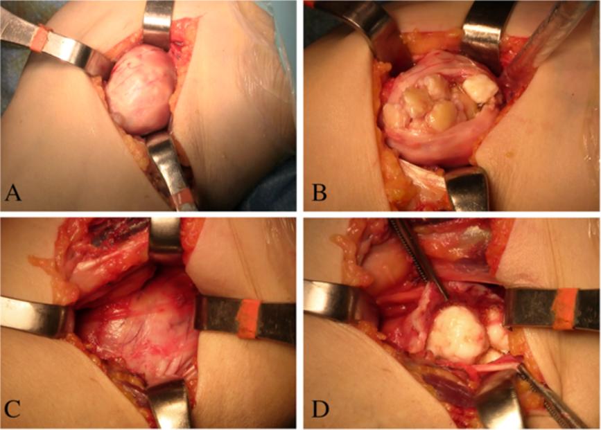 Giannetti et al. World Journal of Surgical Oncology 2013, 11:233 Page 3 of 5 Figure 4 Anterior surgical access to the medial (A,B) and lateral (C,D) compartments of the elbow.