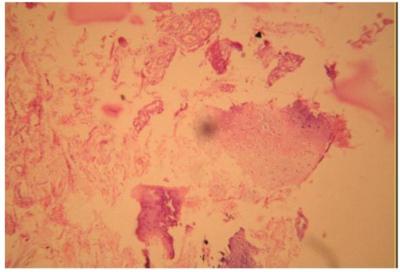 Excised material was sent for histopathological examination. It confirmed diagnosis of synovial chondromatosis (fig.7) without any evidence of malignant changes.