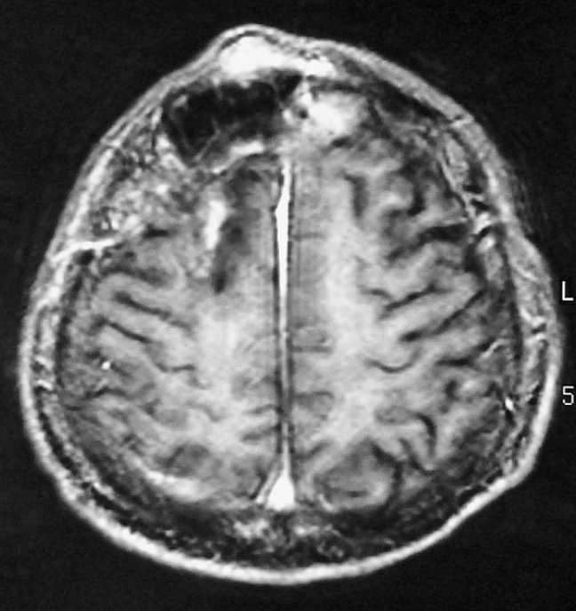 TWO RARE METASTASES FROM HCC AFTER LIVER TRANSPLANTATION SHINYA Fig. 5 Head MRI showing a tumor located near the surgical site in the head. Fig. 4 The pathologic examination showed the bone marrow to be filled with atypical cells.