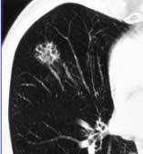 a poorly marginated nodule in the mid-lung.