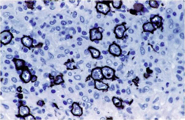 B-cell lymphoma Primary leg type EBV+