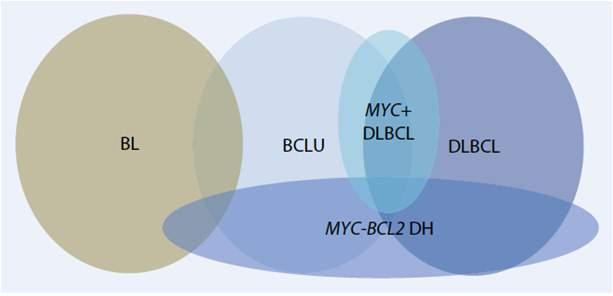 lymphoma unclassified, between DLBCL-BL DLBCL =