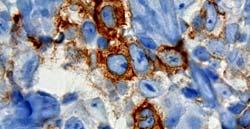 lymphoma cells