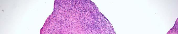 B cell Lymphomas