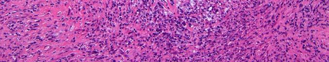 lymphoma B cell