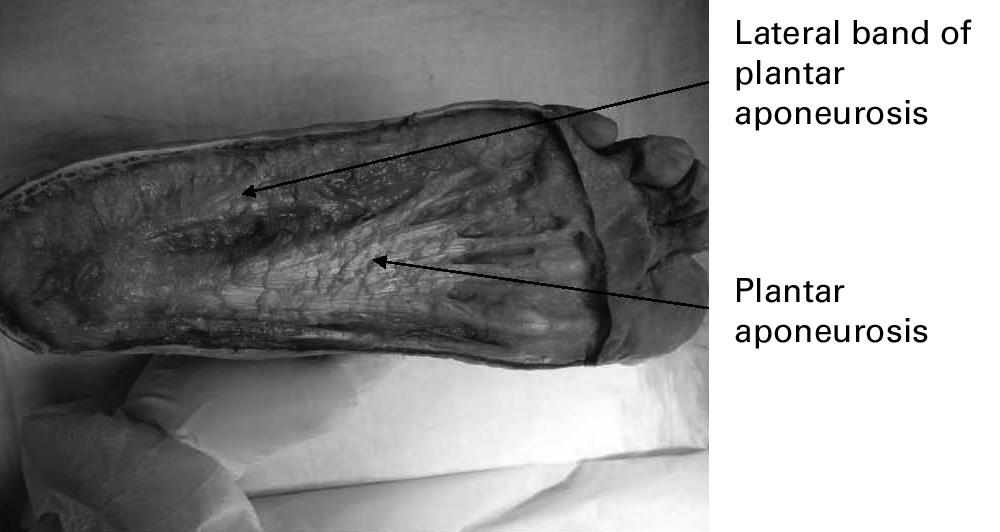 THE MYOFASCIAL COMPARTMENTS OF THE FOOT 1115 Fig. 1 Photograph showing the sole of the right foot. Fig. 2a these small muscles was carried out to identify any fascia overlying them.