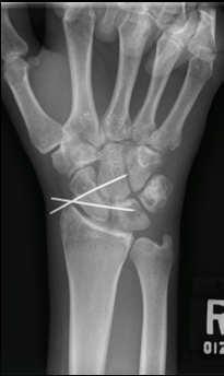 Future Studies: Clinical Long term follow up Pain Arthritis Grip strength Wrist range of motion Scapholunate gap, angle Prospective randomized clinical trial Conclusions When there are >5 proposed
